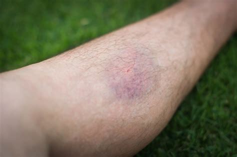 Though bruises also cause some changes to the colour of the skin and even sometimes result in swelling, the causes and wider symptoms of a blood . . Blood clot vs bruise pictures